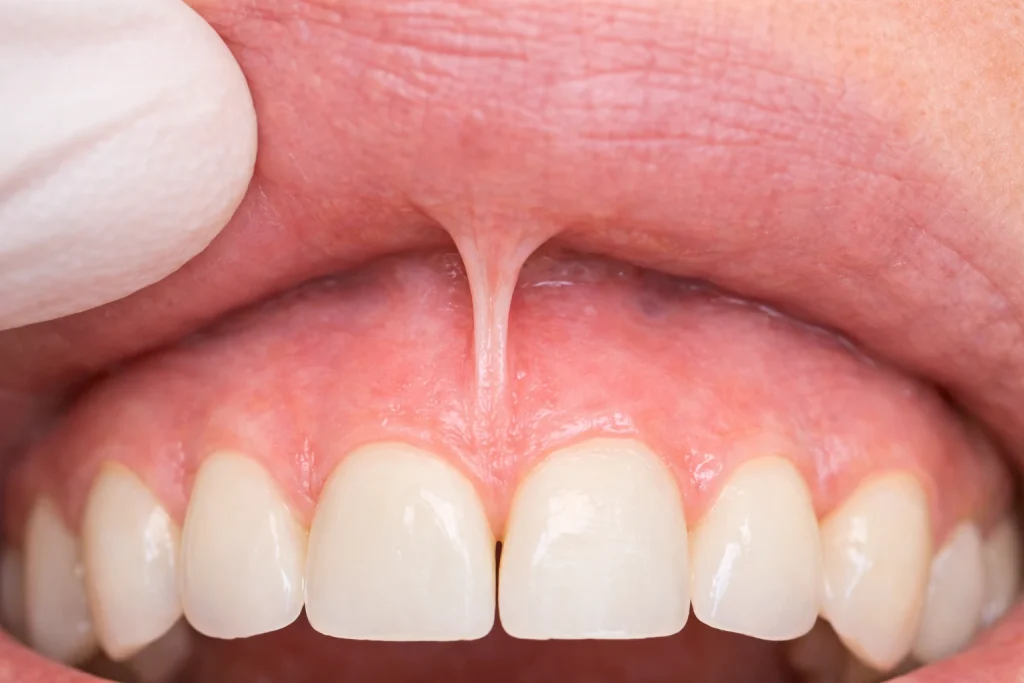 Frein labial supérieur déchiré